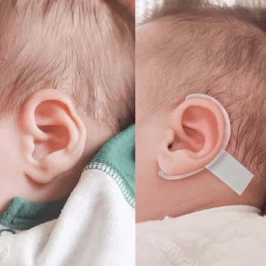 Protruding Ear Support Infant Corrector Tools Silicone Auricle Correction Patch For BabyEar Corrector, Baby Auricle Valgus Corre 2
